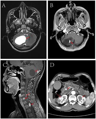 VHL syndrome without clear family history: A rare case report and literature review of Chinese patients